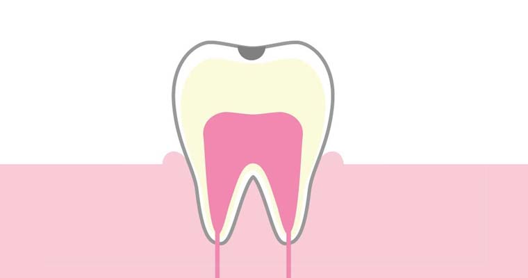 C1：エナメル質内のう蝕