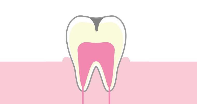 C2：象牙質に達したう蝕